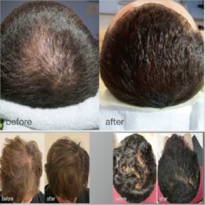 Fotona HAIRrestart Nijmegen 