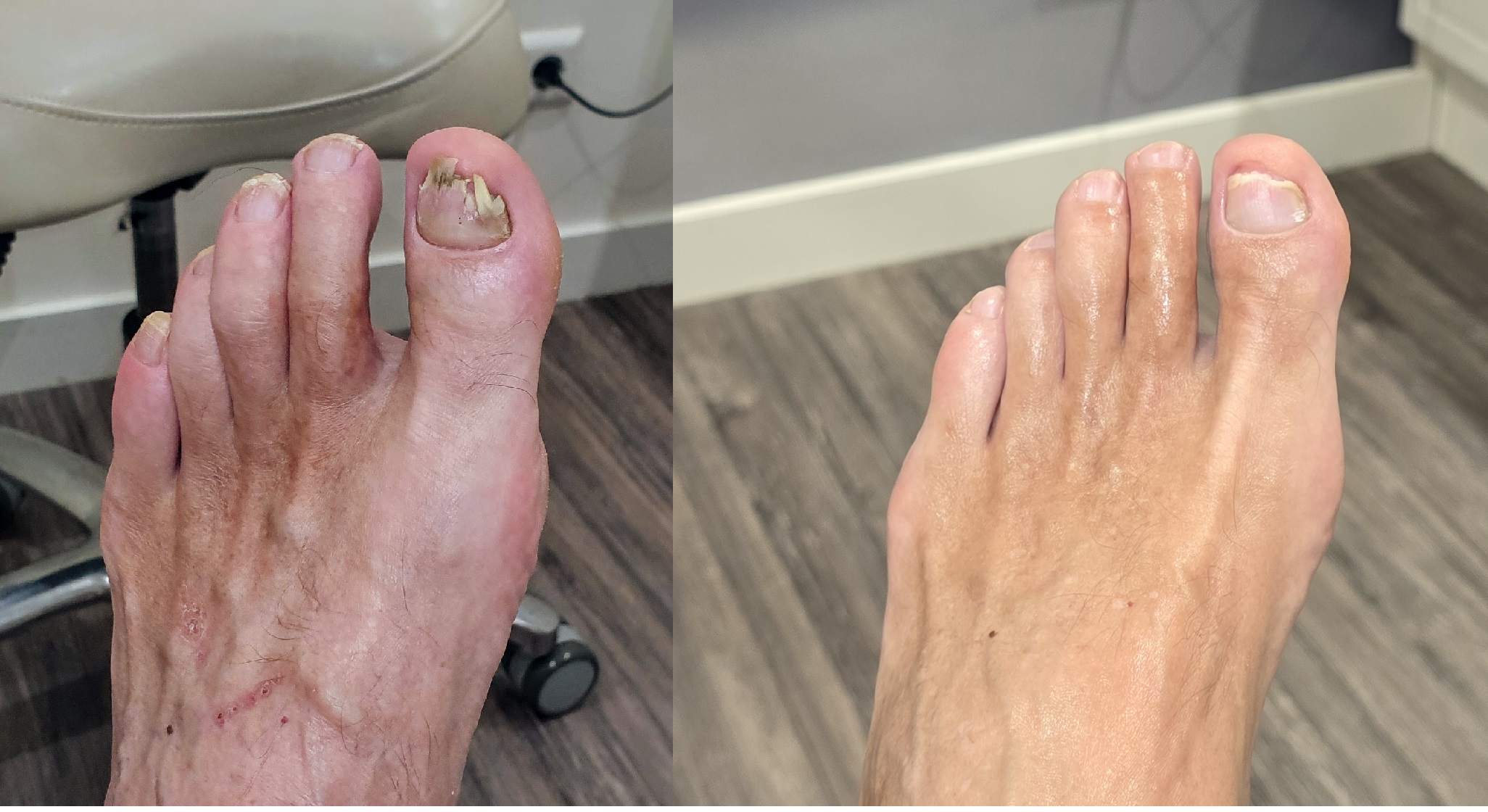 nagel behandeling laser pedicure